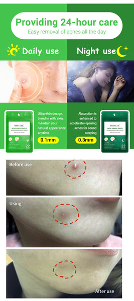 Secure Acne Pimple Patch Face Mask Skin Care Serum Face Cream Mask Facial Care Tools