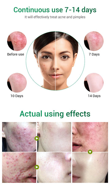 Improve your white tone and remove pimple Acne Pimple Patch Face Mask Skin Care Serum Face Cream Mask Facial Care Tools