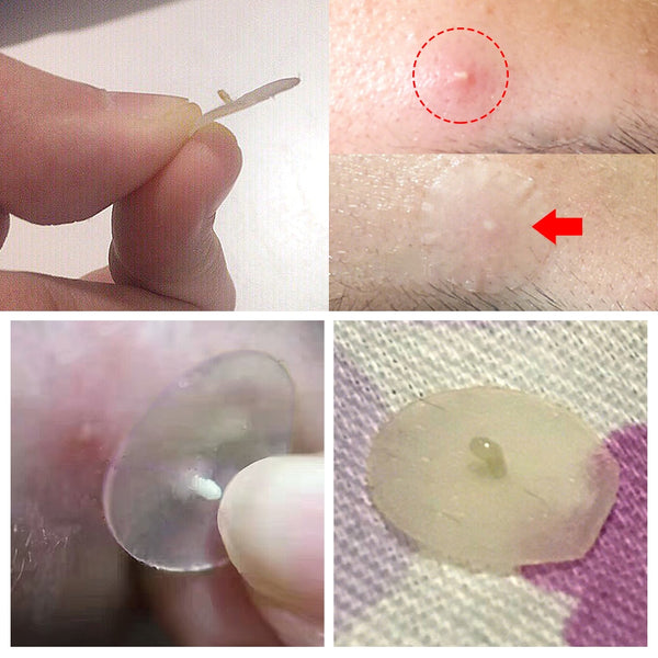 Top selling Acne Pimple Patch Face Mask Skin Care Serum Face Cream Mask Facial Care Tools
