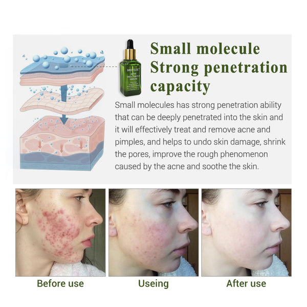 Acne Pimple Patch Face Mask Skin Care Serum Face Cream Mask Facial Care Tools best Buy