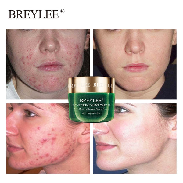 Buy Acne Pimple Patch Face Mask Skin Care Serum Face Cream Mask Facial Care Tools