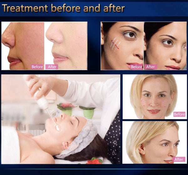 Review of Portable Handheld High Frequency Facial Machine